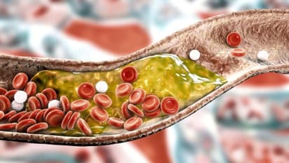 கொலஸ்ட்ரால் அளவு அதிகமாக இருந்தால் இந்த தவறுகளை மட்டும் செய்யாதீங்க.. பல பிரச்சனைகள் ஏற்படலாம்