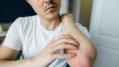 എക്സീമയുടെ ഈ ലക്ഷണങ്ങളെ അറിയാതെ പോകരുത്...