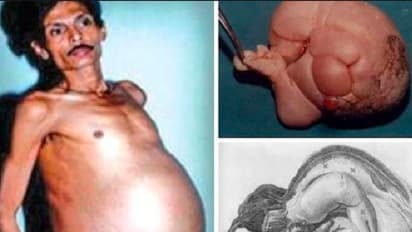 ಪ್ರೆಗ್ನೆಂಟ್ನಂತೆ ಕಾಣುತ್ತಿದ್ದ ವ್ಯಕ್ತಿಯ ಹೊಟ್ಟೆಯೊಳಗೆ 36 ವರ್ಷದಿಂದಲೂ ಬೆಳೀತಿತ್ತು ಆತನದ್ದೇ ಟ್ವಿನ್!