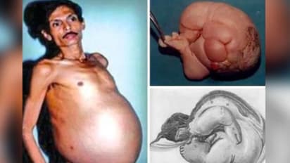 'ഗര്ഭം ധരിച്ച പുരുഷൻ'; വിചിത്രമായ അവസ്ഥയിലൂടെ ജീവിച്ച ഒരാള്...