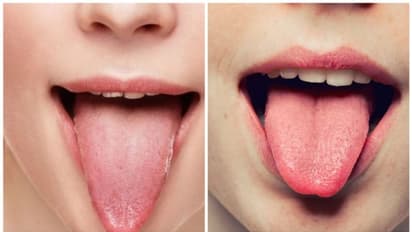 నాలుక రంగు అలా ఉంటే వ్యాధులున్నట్టేనా?