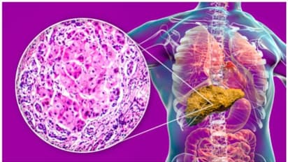 Health Tips :  കരളില്‍ കൊഴുപ്പ് അടിഞ്ഞുകൂടുന്നത് തടയാൻ ആറ് കാര്യങ്ങൾ ശ്രദ്ധിക്കാം 