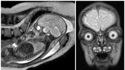 അന്യഗ്രഹ ജീവിയോ? മനുഷ്യഭ്രൂണമോ? ഗര്‍ഭപിണ്ഡത്തിന്‍റെ എംആര്‍ഐ സ്കാനിംഗില്‍ ലഭിച്ചത് ഭയപ്പെടുത്തുന്ന ചിത്രങ്ങള്‍!