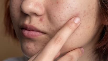 മുഖക്കുരു മാറാൻ ഇത് വീട്ടില്‍ തയ്യാറാക്കി കഴിച്ചുനോക്കൂ...