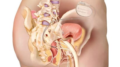 ഓവർ ആക്ടീവ് ബ്ലാഡർ രോഗം ശസ്ത്രക്രിയയിലൂടെ പരിഹരിച്ച് ആസ്റ്റർ മെഡ്സിറ്റി