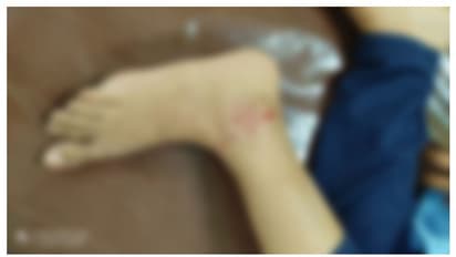 ബൈക്കിൽ പോകുമ്പോൾ പ്ലസ് ടു വിദ്യാർത്ഥിനിക്ക് തെരുവു നായയുടെ കടിയേറ്റു