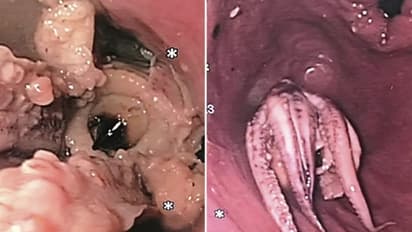 ഛര്‍ദ്ദിയും ശ്വാസതടസവും; ആശുപത്രിയിലെത്തിയ ആളുടെ തൊണ്ടയില്‍ നിന്ന് കണ്ടെടുത്തത്...