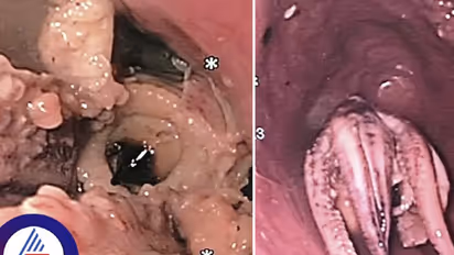 ವ್ಯಾಕ್ ವ್ಯಾಕ್ ಅಂತ ದಿನಪೂರ್ತಿ ವಾಂತಿ ಮಾಡ್ತಿದ್ದ, ಗಂಟಲು ಟೆಸ್ಟ್ ಮಾಡಿದ ವೈದ್ಯರೇ ಬೆಚ್ಚಿಬಿದ್ರು!