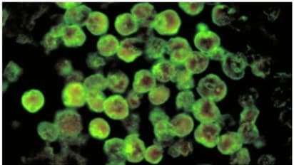 ആലപ്പുഴയിൽ അപൂർവ്വ രോഗം ബാധിച്ച 15കാരൻ മരിച്ചു, ജാഗ്രത വേണം