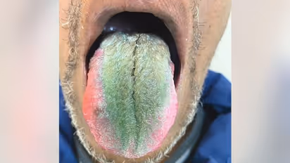 Bizarre! Ohio man develops greens and hairy tongue from smoking and antibiotics