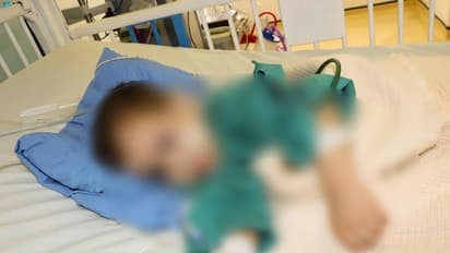 ഒരാഴ്ച മുമ്പ് വേർപെടുത്തിയ സയാമീസ് ഇരട്ടക്കുട്ടികളിൽ ഒരാൾ മരിച്ചു