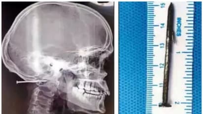 അസഹനീയമായ വേദന; സഹപ്രവര്ത്തകന്റെ ഗണ്ണില് നിന്ന് അബദ്ധത്തില് ഉതിര്ന്ന ആണി യുവാവിന്റെ തലയില് തുളഞ്ഞുകയറി