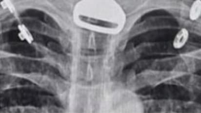 കടുത്ത ശ്വാസംമുട്ട്, 49 കാരനെ ആശുപത്രിയിലെത്തിച്ചു; പരിശോധനക്കിടെ എക്‌സ് റേ എടുത്തപ്പോൾ ഞെട്ടി ഡോക്ടര്‍മാര്‍ !