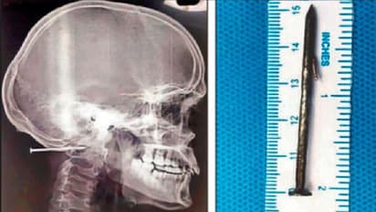 ಕಾರ್ಮಿಕನ ತಲೆ ಹೊಕ್ಕಿದ 2 ಇಂಚು ಉದ್ದದ ಮೊಳೆ : ಡ್ರಿಲ್ ಮಾಡಿ ಹೊರತೆಗೆದ ವೈದ್ಯರು