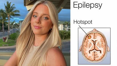 What is epilepsy symptoms, causes and treatment in hindi