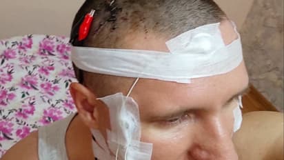 ಯೂಟ್ಯೂಬ್ ವಿಡಿಯೋ ನೋಡಿ ಮೆದುಳಿಗೆ ಚಿಪ್ ಅಳವಡಿಸಿಕೊಳ್ಳಲು ಸ್ವಯಂ ಆಪರೇಷನ್ ಮಾಡ್ಕೊಂಡ ಭೂಪ: ಆಮೇಲೇನಾಯ್ತು ನೋಡಿ..