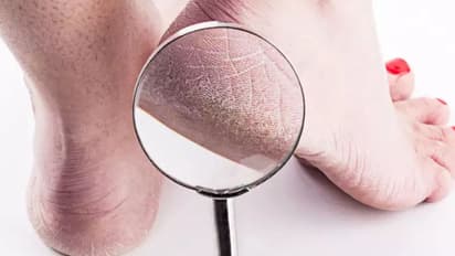 Effective home remedies for cracked heels