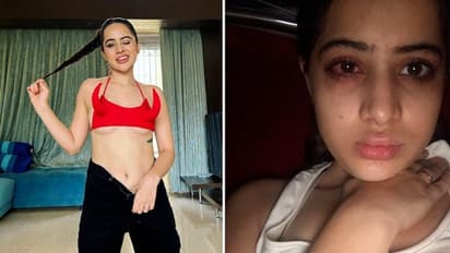 Urfi Javed opens up on her painful 'lip filler' journey; Here's what she said