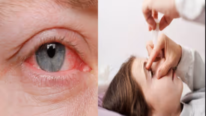 Conjunctivitis