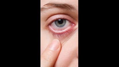 Health Tips: కంటి దురద, వాపుతో బాధపడుతున్నారా.. అయితే ఈ జాగ్రత్తలు మీకోసమే?