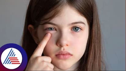 ಮಳೆ ನಡುವೆ ಬೆಂಗಳೂರಿನ ಮಕ್ಕಳಲ್ಲಿ Madras eye ಸೋಂಕು ಹೆಚ್ಚಳ!  