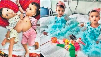 ಒಬ್ಬರಲ್ಲ ನಾವೀಗ ಇಬ್ಬರು: ಸಯಾಮಿ ಅವಳಿಗಳಿಗೆ ಯಶಸ್ವಿ ಶಸ್ತ್ರಚಿಕಿತ್ಸೆ ಮಾಡಿದ ಏಮ್ಸ್ ಆಸ್ಪತ್ರೆ