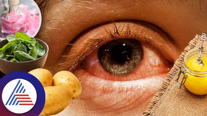 ಕಣ್ಣಿನ ಸೋಂಕಿಗೆ ಮನೆ ಮದ್ದು: ಅನಾರೋಗ್ಯಕ್ಕೆ ಹೇಳಿ ಗುಡ್ ಬೈ