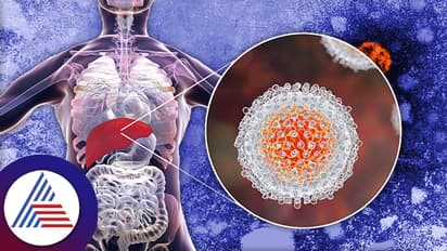 Health Tips: ಹೆಪಟೈಟಿಸ್ ಸೋಂಕು ಹೇಗೆ ಲಿವರ್ ಹಾಳು ಮಾಡುತ್ತೆ? ಜಗತ್ತನ್ನೇ ಕಾಡ್ತಾ ಇರೋ ರೋಗದ ಬಗ್ಗೆ ಎಚ್ಚರ!