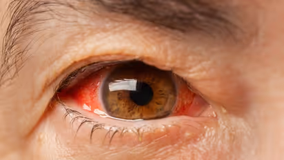 The Silent Onslaught - Pink eye (conjunctivitis) epidemic strikes during monsoon