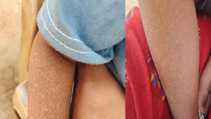 ಚಾಮರಾಜನಗರದಲ್ಲಿ ಮಕ್ಕಳನ್ನು ಭಾದಿಸುತ್ತಿದೆ ವಿಚಿತ್ರ ಚರ್ಮರೋಗ!