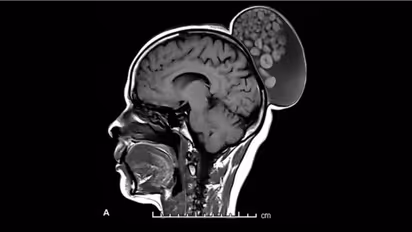 കുട്ടിക്കാലം മുതൽ സ്ത്രീയുടെ തലയിൽ മുഴ, വേദനയില്ല, എംആർഐ സ്കാനിൽ ഉള്ളിൽ കണ്ടത് ഗോളരൂപങ്ങൾ, ശസ്ത്രക്രിയ വിജയം