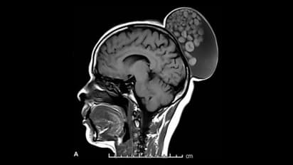 Bengaluru : பெண்ணின் உச்சந்தலையில் வளர்ந்த கட்டி.. அறுவை சிகிச்சையை வெற்றிகரமாக முடித்த மருத்துவர்கள்