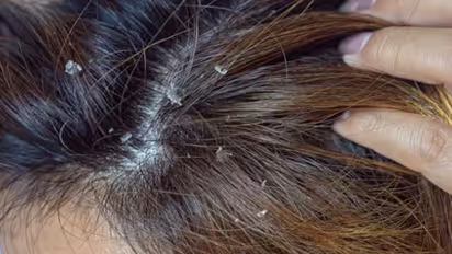 ഇത് താരനല്ല, തലയോട്ടിയില് കാണുന്ന ഈ ലക്ഷണങ്ങള് നിസാരമായി കാണരുത്...