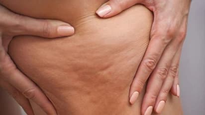 എന്തുകൊണ്ടാണ് ശരീരത്തില് ചിലയിടങ്ങളില് ഇങ്ങനെ ചെറിയ മുഴകള് പോലെ കാണുന്നത്?