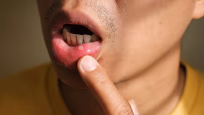 Health Tips: വായ്പ്പുണ്ണ് മൂലം അസഹ്യമായ വേദനയോ? വീട്ടില് പരീക്ഷിക്കാം ഇക്കാര്യങ്ങള്...