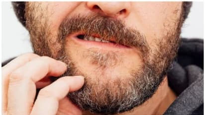 താടിയിൽ താരനോ ? ശ്രദ്ധിക്കാം ഇക്കാര്യങ്ങൾ