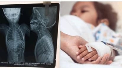 தவறுதலாக ஊக்கை விழுங்கிய 2- வயது குழந்தை.. சாதித்து காட்டிய திருச்சி அரசு மருத்துவமனை