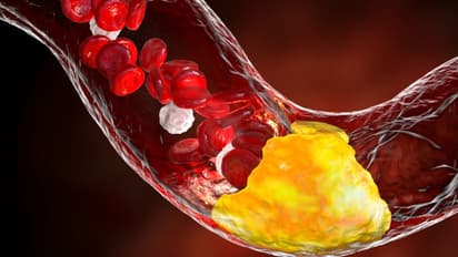  കൊളസ്ട്രോൾ നിയന്ത്രിക്കാൻ സഹായിക്കുന്ന അഞ്ച് പഴങ്ങൾ 