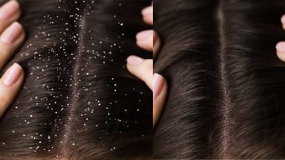 Hair care: చుండ్రు తగ్గి.. జుట్టు ఒత్తుగా పెరగాలంటే ఈ 5 చేస్తే చాలు!