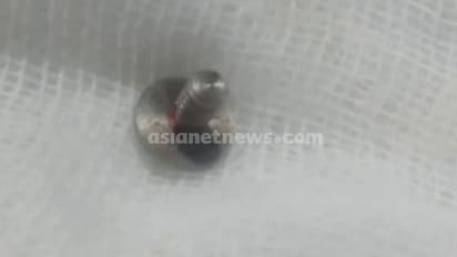 Kerala: Surgical clip left in teenager's stomach after surgery; Family accuses Thrissur private hospital