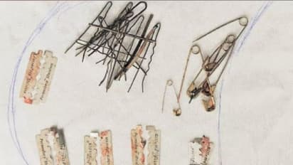 ಹೊಟ್ಟೆಯೊಳಗೇನು ಬ್ಯೂಟಿಪಾರ್ಲರ್ ಇಟ್ಕೊಂಡಿದ್ನಾ : ವ್ಯಕ್ತಿ ಹೊಟ್ಟೆಯಲ್ಲಿದ್ದ ವಸ್ತುಗಳ ನೋಡಿ ವೈದ್ಯರೇ ಶಾಕ್