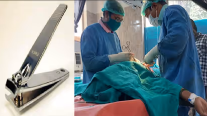 Bengaluru doctors remove nail cutter from man's stomach after 8 years
