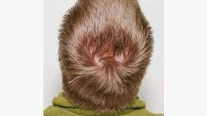 தலையில் இரட்டை சுழி இருந்தால் இரண்டு திருமணமா? உண்மையான காரணம் இங்கே..!!