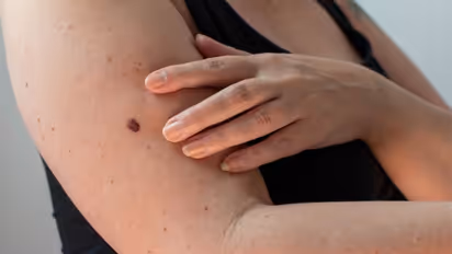 സ്കിന്‍ ക്യാന്‍സര്‍ സാധ്യത കുറയ്ക്കാന്‍ ശ്രദ്ധിക്കേണ്ട കാര്യങ്ങള്‍...