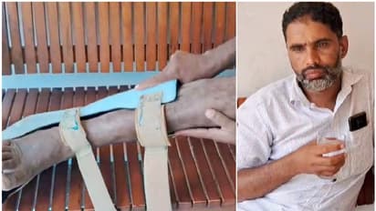 നടന്ന് എത്തി, കാലിലെ ഞരമ്പ് മാറി ശസ്ത്രക്രിയ; പിന്നെ നടത്തിയത് 11 ശസ്ത്രക്രിയകള്, ചലനശേഷി നഷ്ടപ്പെട്ട് യുവാവ്