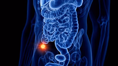 What is appendix cancer? Know the common symptoms and recognise the warning signs
