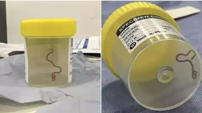 സ്ത്രീയുടെ തലച്ചോറില്‍ നിന്നും ജീവനുള്ള വിരയെ കണ്ടെത്തി; ഇത് ഞെട്ടിക്കുന്ന അനുഭവം