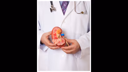 ನೀರು ಬಿಟ್ಟು, ಬಬಲ್ ಟೀ ಸಾಕೆಂದ ಮಹಿಳೆ ಮೂತ್ರಪಿಂಡದಲ್ಲಿತ್ತು ಬರೊಬ್ಬರಿ 300  ಕಲ್ಲು!