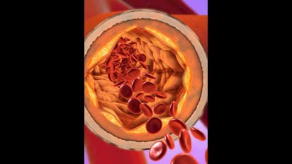 మందులు వాడకుండా కొలెస్ట్రాల్ ను తగ్గించుకోవడం ఎలా? 