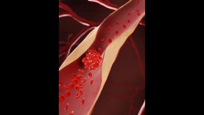 ഉയർന്ന കൊളസ്ട്രോൾ ; ശരീരം കാണിക്കുന്ന ഈ ലക്ഷണങ്ങൾ അവഗണിക്കരുത്